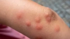 Alergie la mușcături