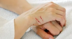 Boli transmise prin mușcături și zgârieturi