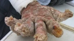 Ce este fitilosisul periculos: simptome și tratament