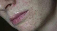 Demodecoză: ce este, simptome și tratament