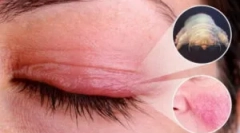 Demodecoză: cauze, simptome și tratament