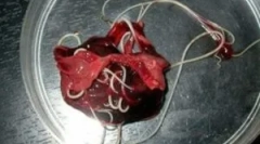 Viermi în țesuturile hepatice