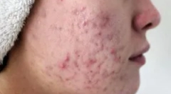 Cum este transmis demodicoza?