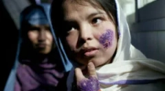 Cum se infectează cu leishmeni: simptome și tratament al leishmaniozei