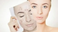 Tratamentul demodicozei pe fața unei persoane