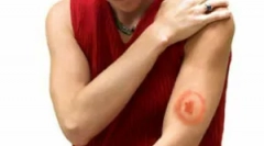 Tratamentul borreliozei bord-borne