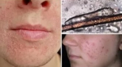 Analiza de livrare pe demodecoză