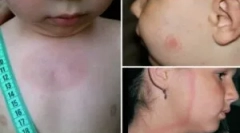 Simptomele și tratamentul borreliozei la un copil