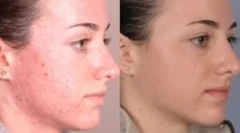 Mijloace pentru tratamentul demodicozei