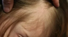 Păduchi și pantaloni scurți în părul ei într-un copil